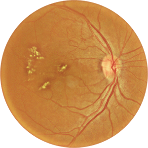 A circular image of the retina in the eye with spots indicating the presence of Age-related macular degeneration.